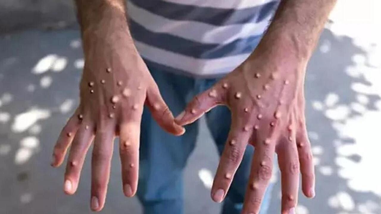 “Meymunçiçəyi”ndən ölənlərin sayı açıqlandı – Xəstəlik sürətlə yayılmaqda davam edir