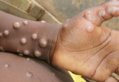 ÜST Afrikada meymun çiçəyi epidemiyasını fövqəladə vəziyyət elan etdi