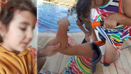 Lənkəranda qandonduran HADİSƏ – Ana isti qaşıqla 3 yaşlı qızının qolunu DAĞLADI – FOTO