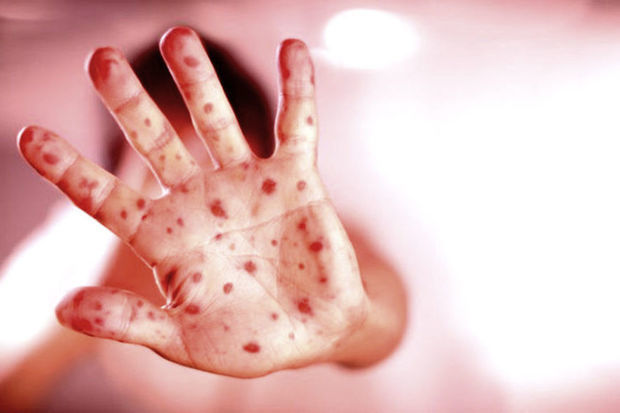 Bu ölkədə qızılca epidemiyası elan edildi