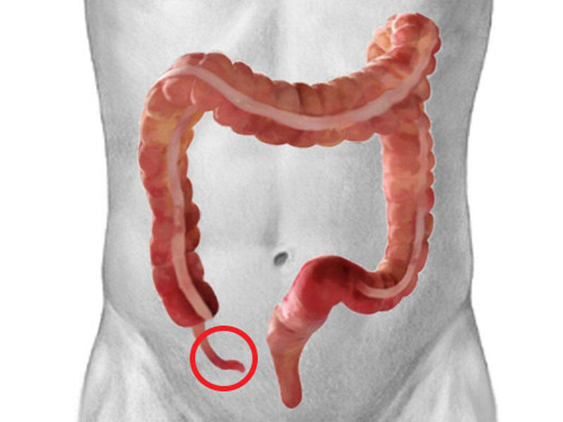 Appendiks... xərçəngdən qoruyur