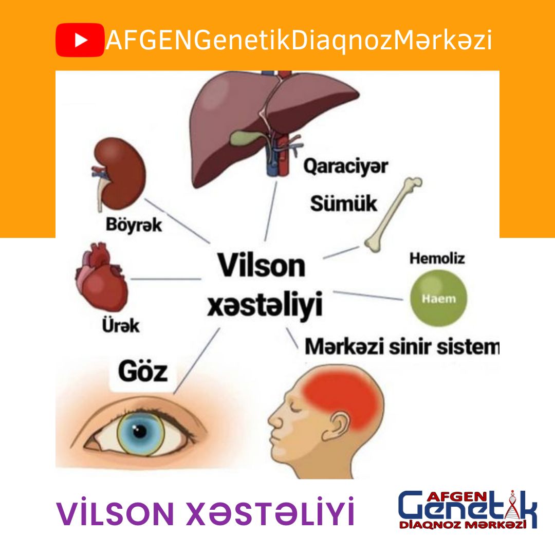 Bədəndə misi çoxaldan Wilson xəstəliyi - Əlamətləri